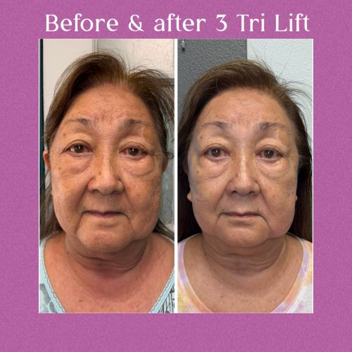 Exclusive Tri Lift